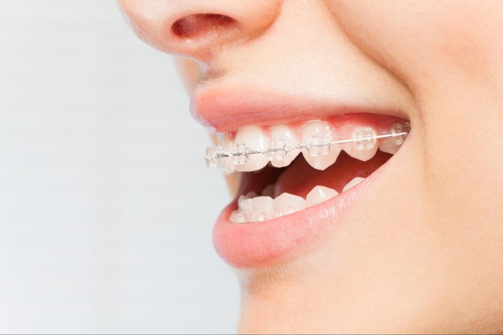 The Most Discreet Orthodontic Options for Adult