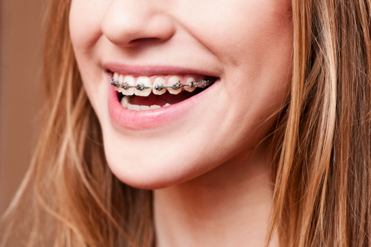 Girl smiling with braces