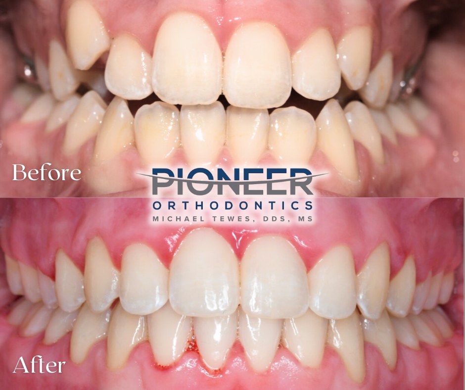 Before and after braces results at Pioneer Orthodontics in Lincoln, Nebraska